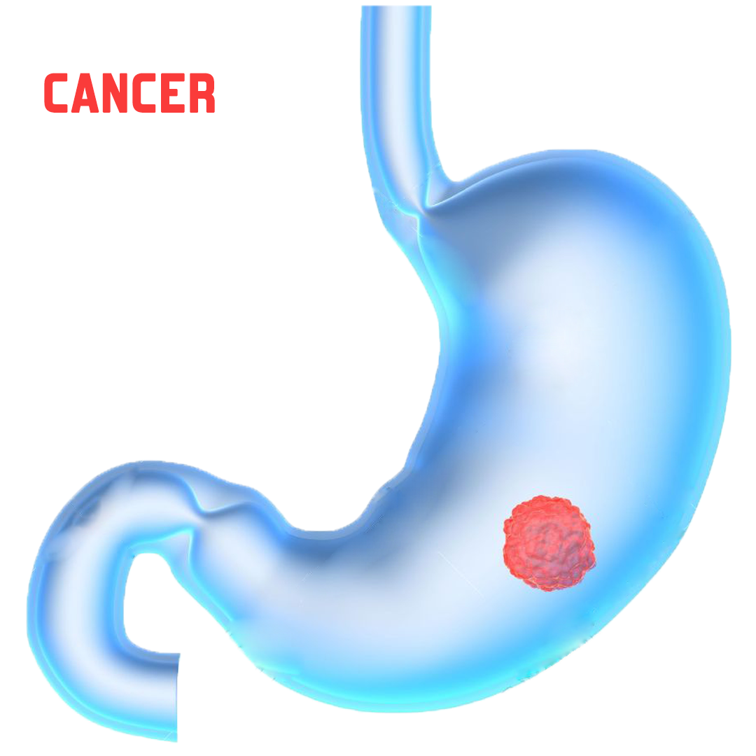 Stomach Cancer Screening for self and family Tests and Guidelines